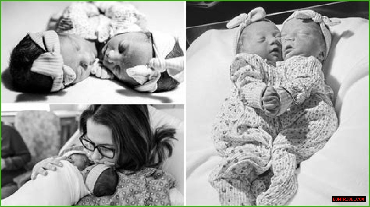**The Inspiring Journey Of Matthew And Breana Dell: Conjoined Twins**